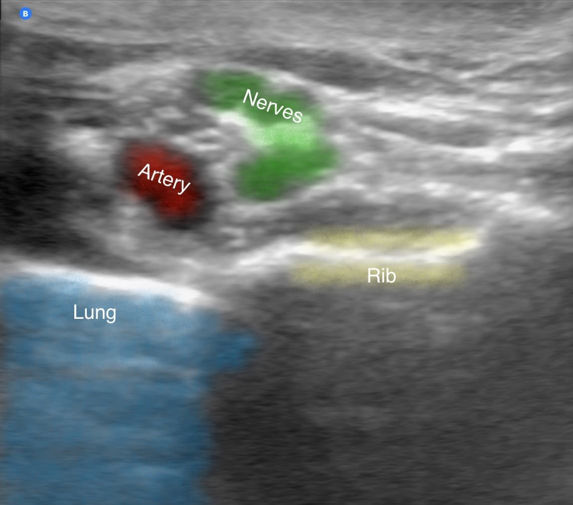 Supraclavicular Ultrasound showing the concept of Portable Ultrasound in the Pain Clinic